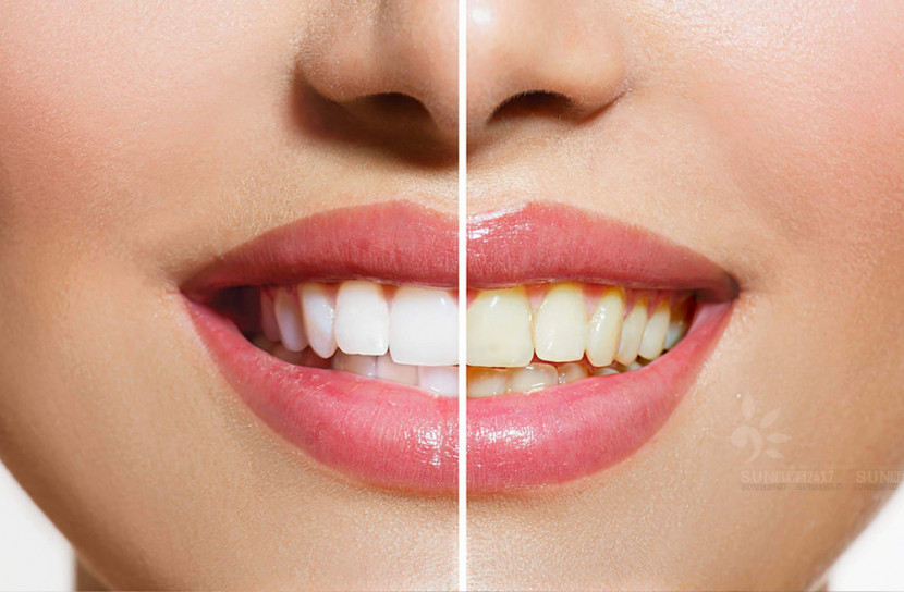 দাঁত সাদা করার ৫ উপায়