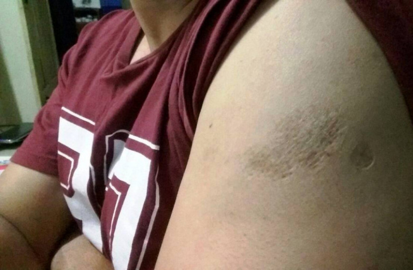 শৈশবে দেয়া বিসিজি টিকা করোনা থেকে বাঁচাবে!