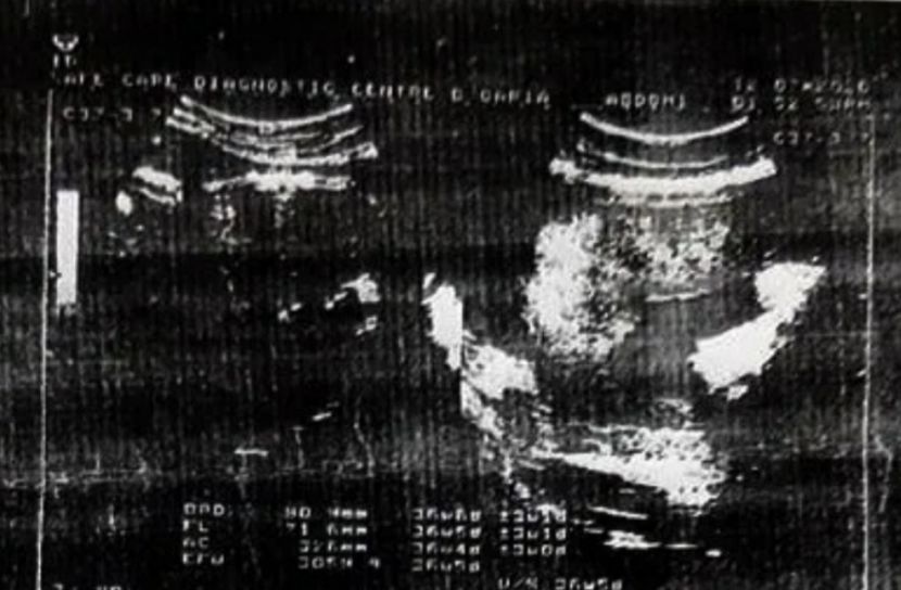 আলট্রাসনোগ্রাম রির্পোট নিয়ে বিড়ম্বনা