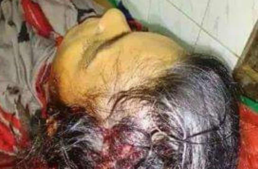 গুরুতর আহত গৃহবধূ রুপার অবস্থা সংকটাপন্ন