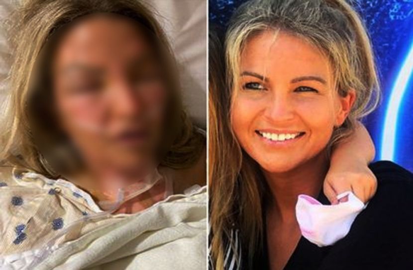 স্যানিটাইজারের বোতল বিস্ফোরণে দগ্ধ নারী