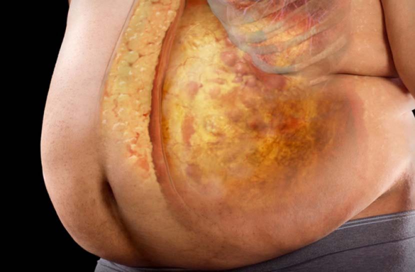 শরীরে চর্বি  জমার কারণ ও প্রতিকার