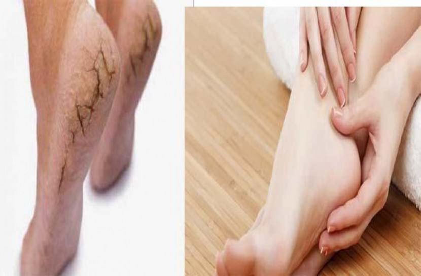 পা ফাটার সমস্যা দূর করুন ২ দিনেই