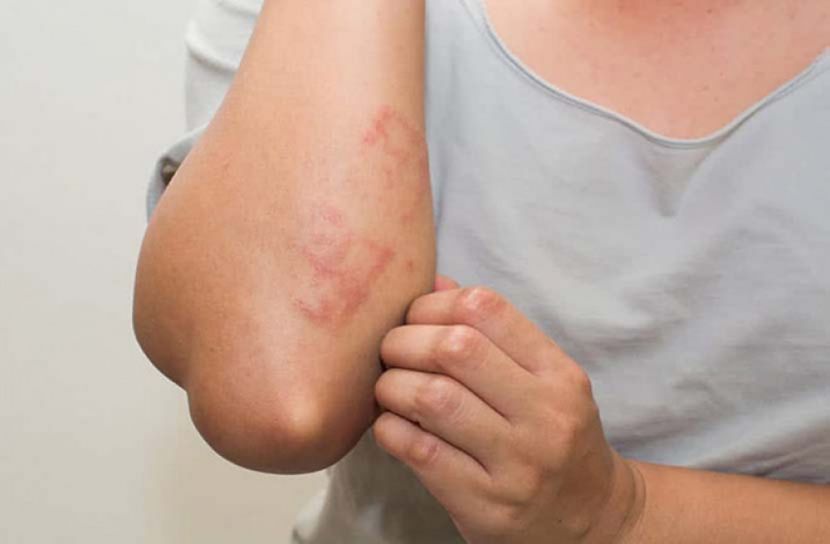 শীতে ত্বকের বিভিন্ন ধরনের র‍্যাশ