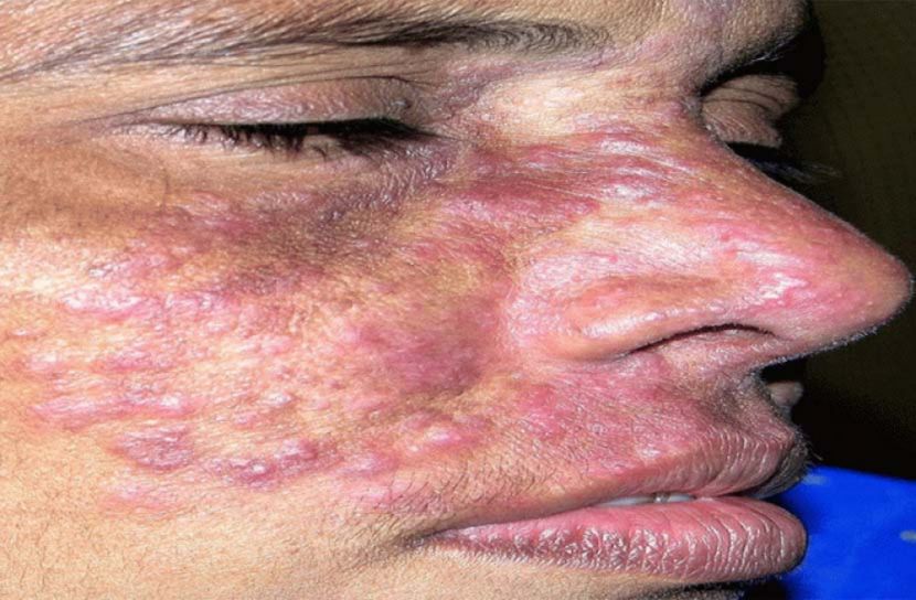 ফর্সা হওয়ার ক্রিম মাখলেই সর্বনাশ!