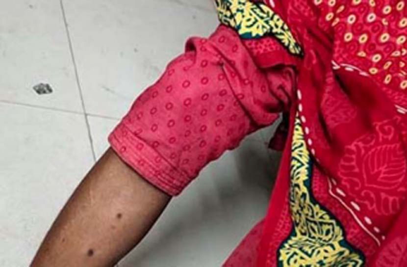 স্বামীর সিগারেটের ছ্যাঁকায় হাসপাতালে গৃহবধূ