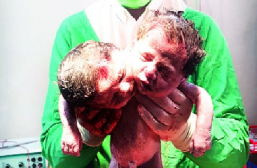 দুই মাথাওয়ালা শিশু দেখতে হাসপাতালে মানুষের ভিড়