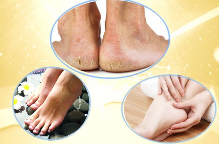 পা ফাটছে? জেনে নিন সমাধান