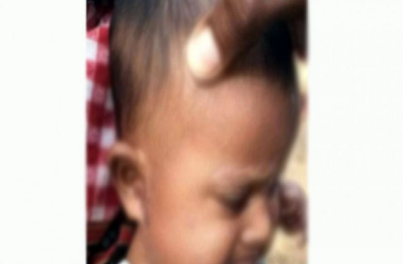 ৬ মাসের শিশুর বিশেষ অঙ্গে এসিড নিক্ষেপ