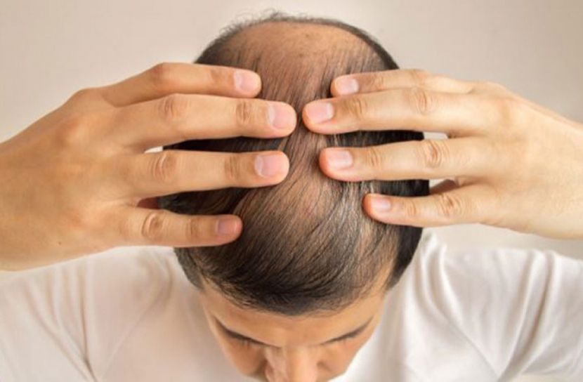 চুলপড়া রোধে কার্যকরী ওষুধ আবিষ্কার থাই বিজ্ঞানীদের