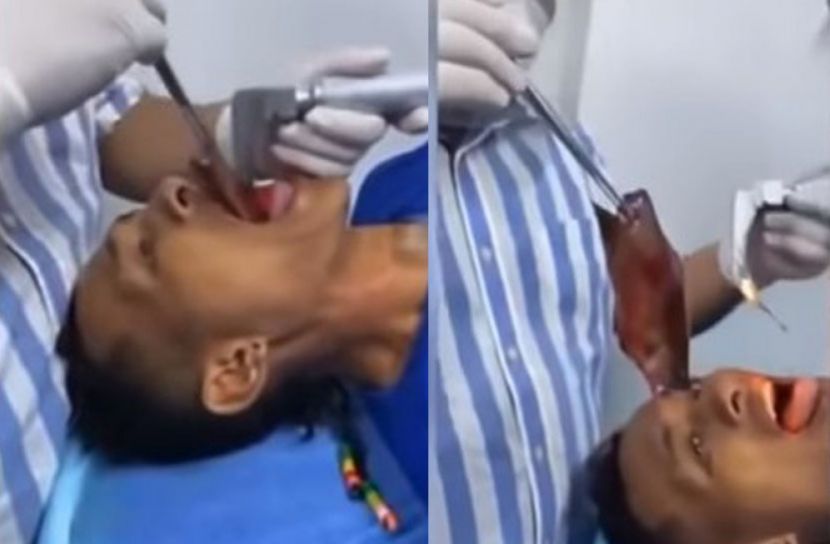 গলা থেকে বের করা হলো সাত ইঞ্চি লম্বা মাছ