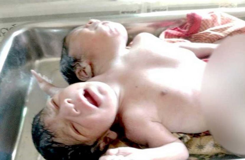 বিরল জোড়া লাগা যমজের জন্ম