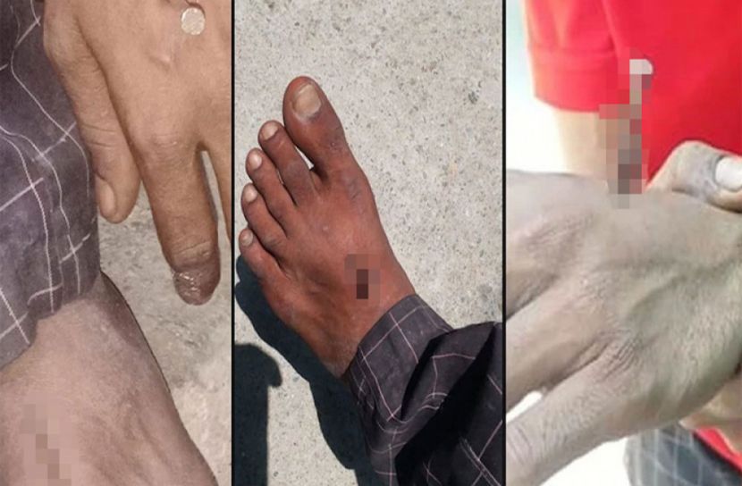 মাস্ক না পরায় হাত-পায়ে পেরেক!