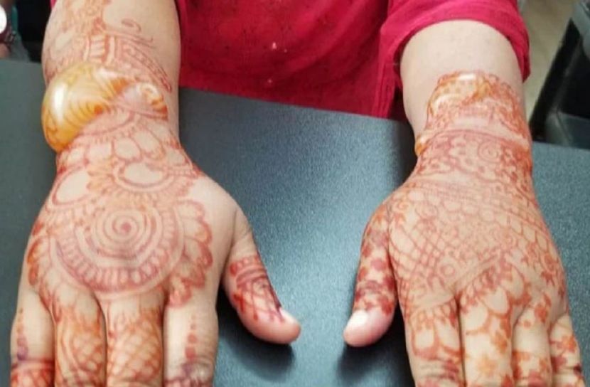 মেহেদী দিয়ে হাতে ফোসকা, ১ লাখ টাকা জরিমানা