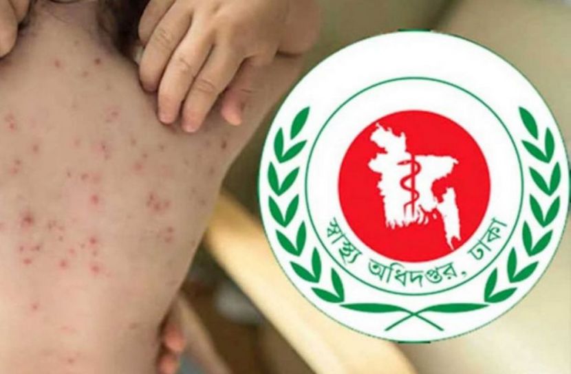 হাম উপসর্গে আরও ৬ শিশুর মৃত্যু