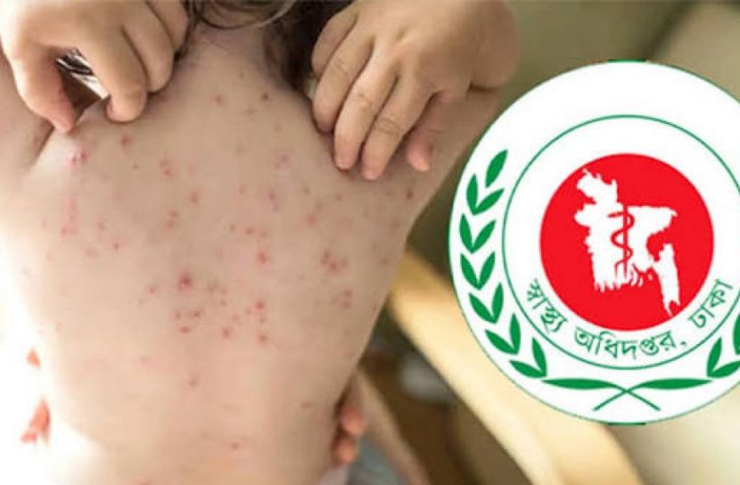 হাম ও উপসর্গে আরও ৬ জনের মৃত্যু